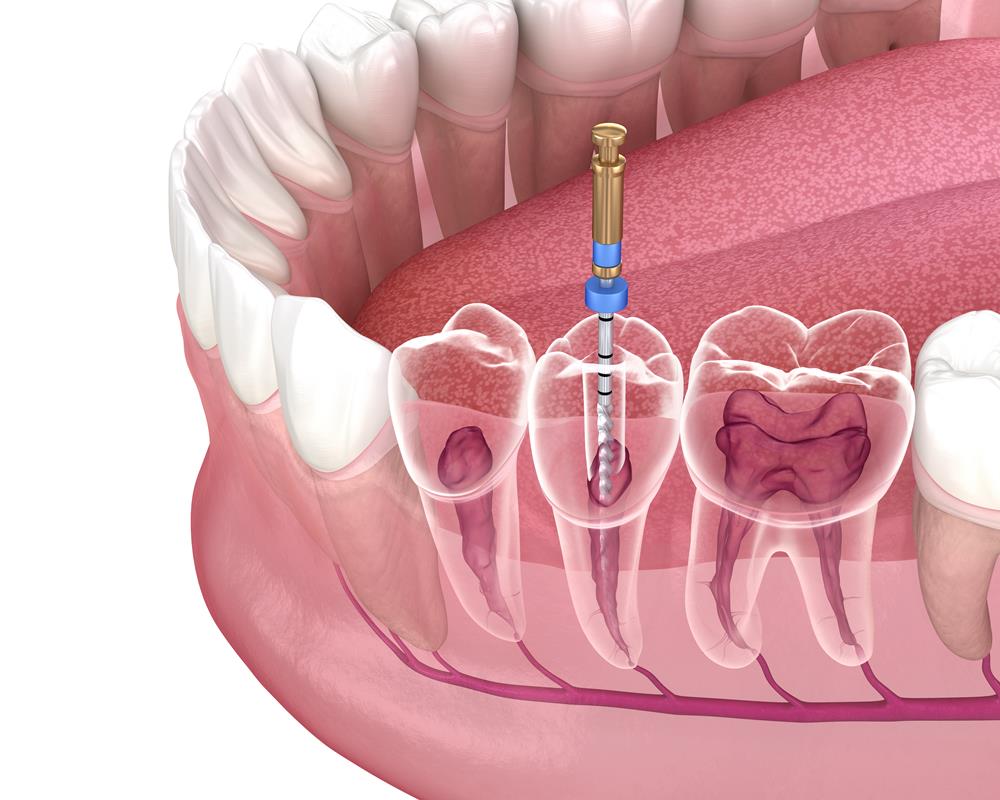 Root canal medical illustration